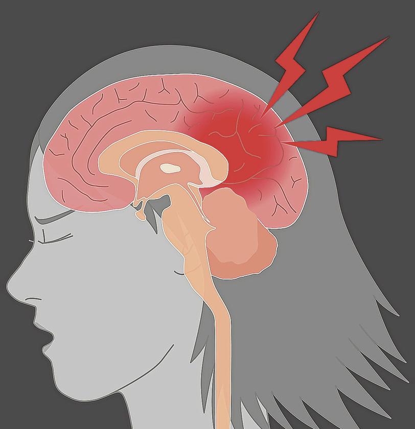 Men and women are different, even when it comes to strokes